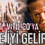 vitiligoya ne iyi gelir