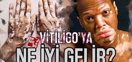 vitiligoya ne iyi gelir